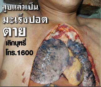 Thailand 2009 Health Effects lung - lung cancer, lived experience